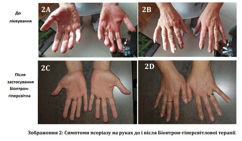 Bioptron-hands.jpg