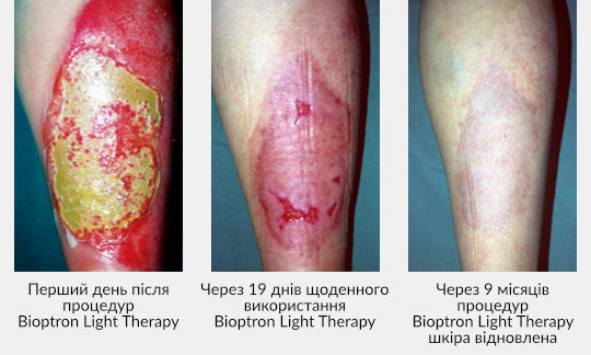 Zepter-Bioptron-wounds